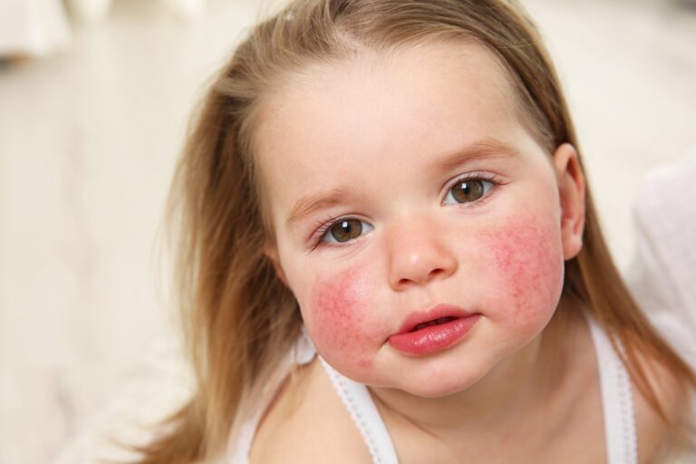 Naviguer dans les régimes d&rsquo;élimination chez les enfants allergiques sans compromettre la nutrition