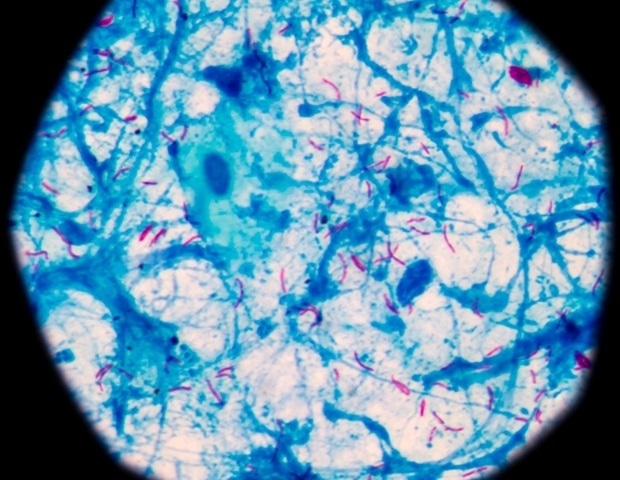Redéfinir la classification de la tuberculose pour améliorer la détection et le traitement précoces