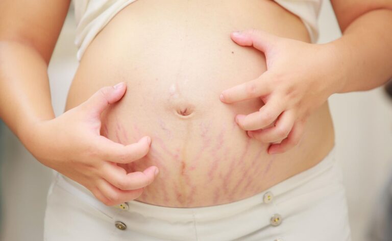 Éruption PUPPP pendant la grossesse : symptômes, causes et traitement