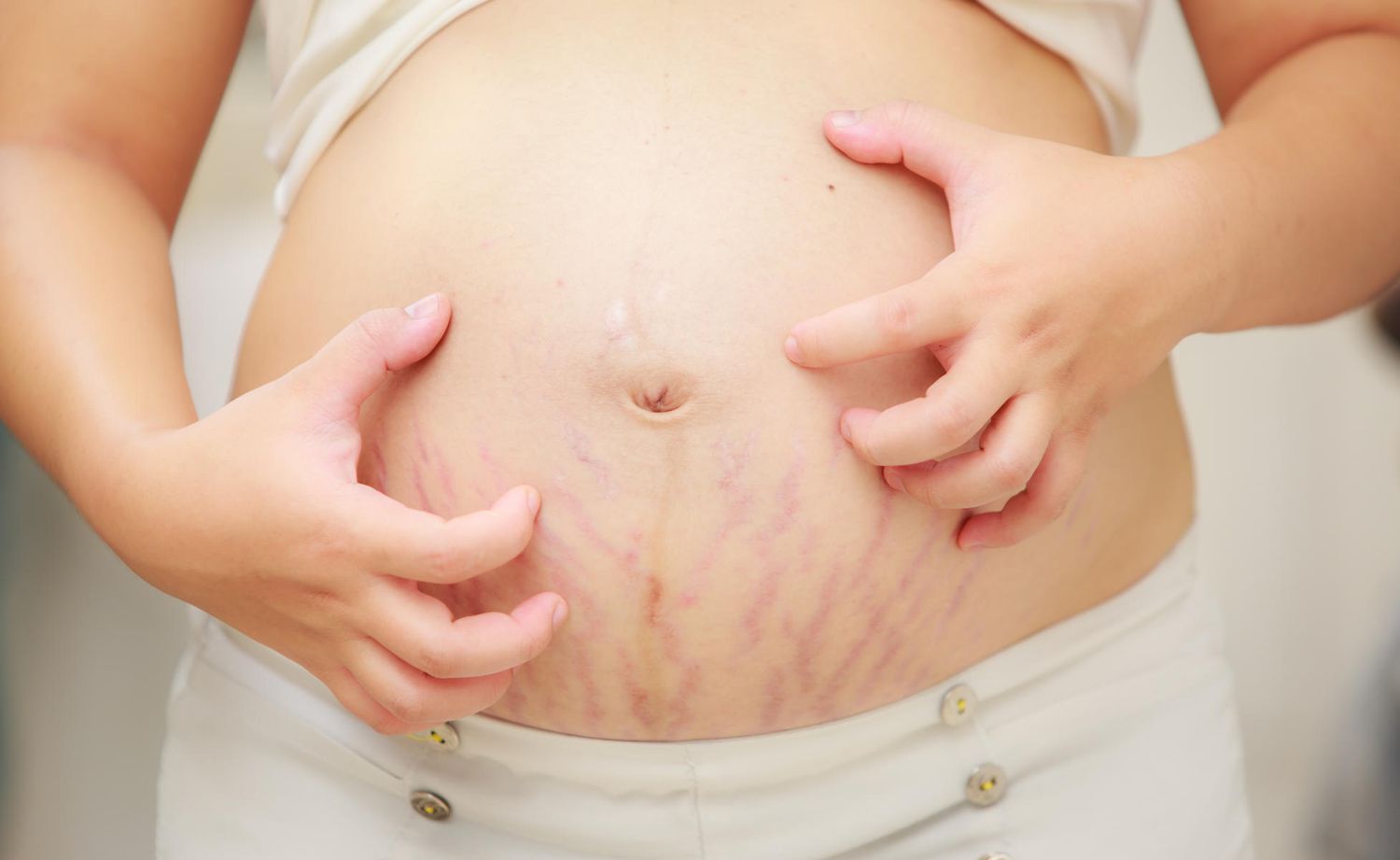 Éruption PUPPP pendant la grossesse : symptômes, causes et traitement