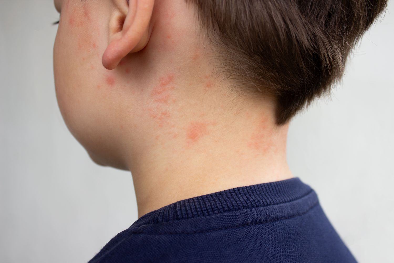L'épidémie de rougeole en Caroline du Sud s'accentue : ce qu'il faut savoir